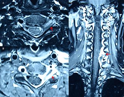 Spinal Intrathecal Actinomycosis Causes Multisegmental Root Failure: A Case Report